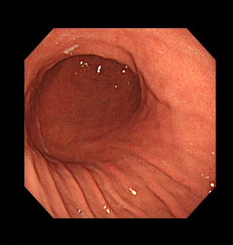 胃カメラ（上部消化管内視鏡）とピロリ菌